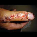 finger injury caused by a lump hammer